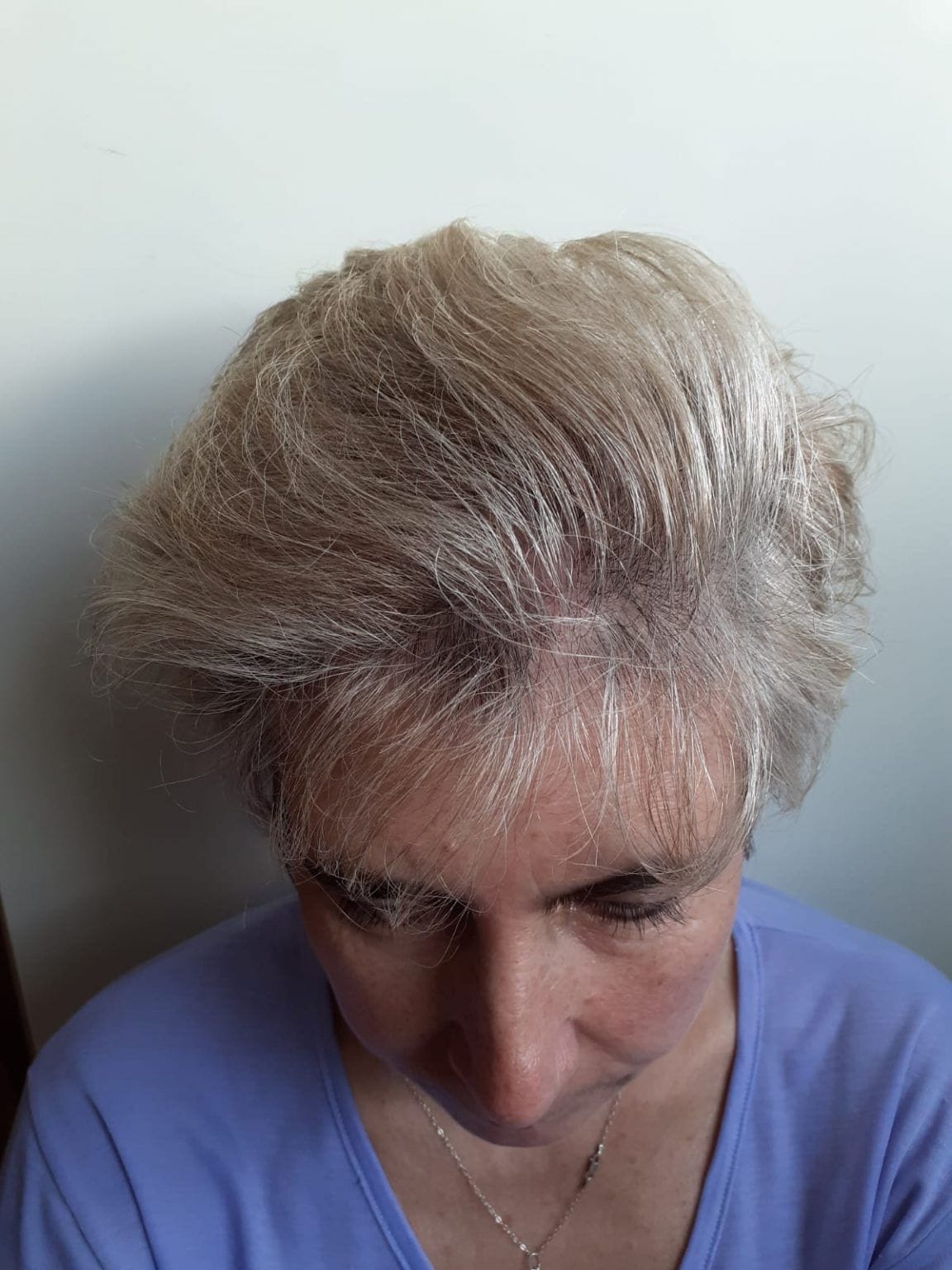Demo placeholder — after image, not an actual patient