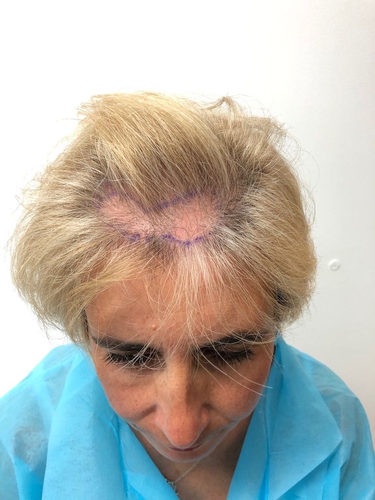Hairline restoration illustrative image